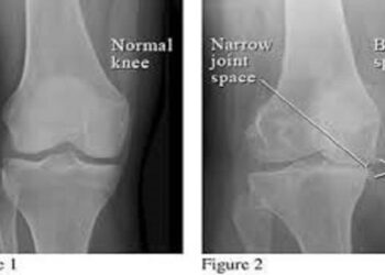 osteoarthritis