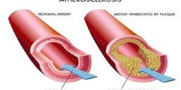 atherioslerosis