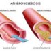 atherioslerosis